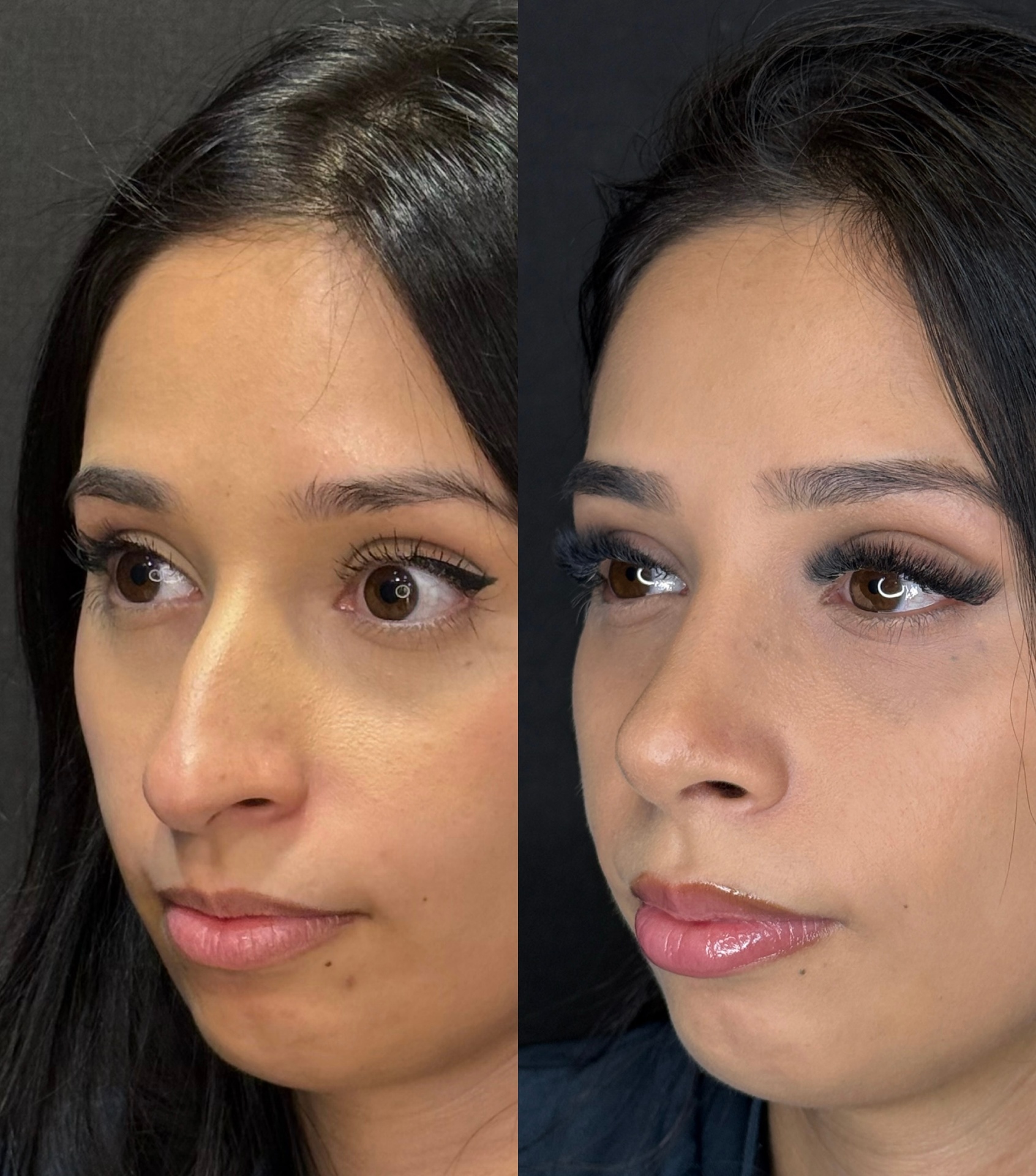 Resultado antes e depois de rinoplastia realizada pelo Dr. Cristiano Kipper